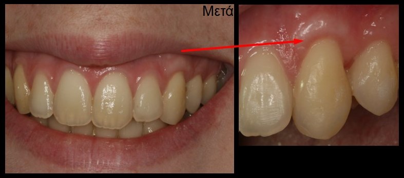 Κάλυψη της υποχώρησης ούλου με μόσχευμα ούλου